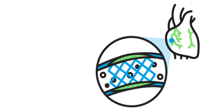 La Angioplastia Coronaria Con Stent En El Cl Nic