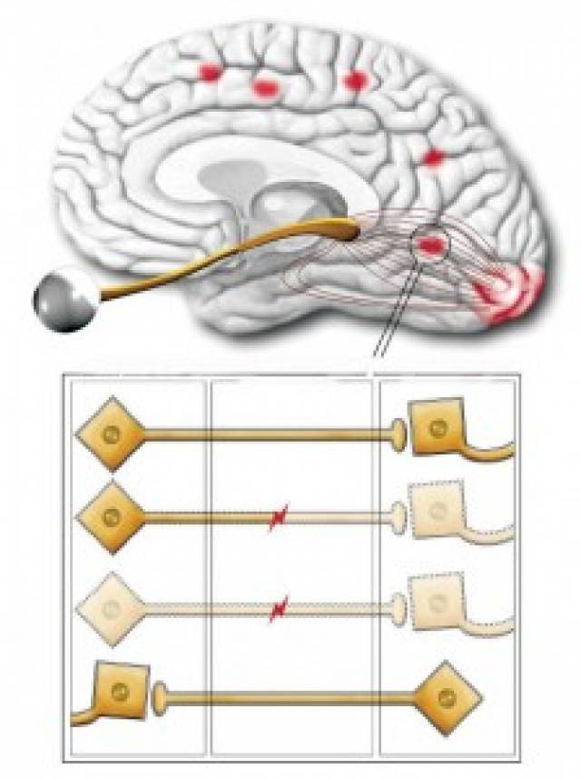 Scheme of the raising of the study published at Archives of Neurology