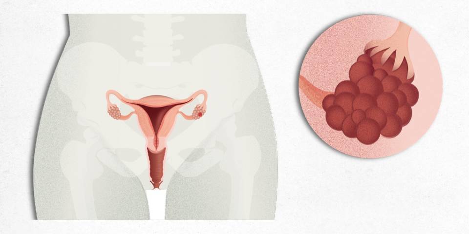 Anatomia de l'aparell reproductor femení, tumor ovari, càncer d'ovaris